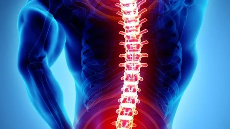 Espondilitis anquilosante: Un desafío más allá del dolor de columna