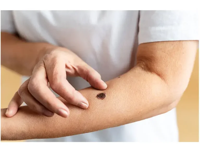 Melanoma: el alarmante aumento y su relación con la posición socioeconómica